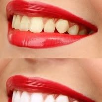 Aesthetic Smile Design Treatment